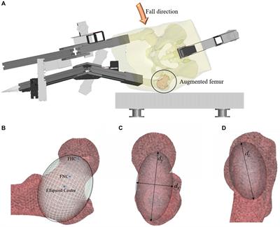 The efficacy of femoral augmentation for hip fracture prevention using ceramic-based cements: A preliminary experimentally-driven finite element investigation